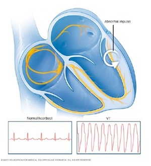 arrhythmia diagram