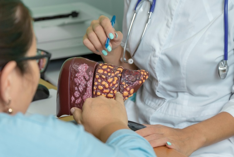 Patient looking at model of liver with fatty liver disease.
