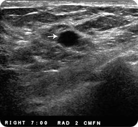 A possible cyst in the patient’s breast.